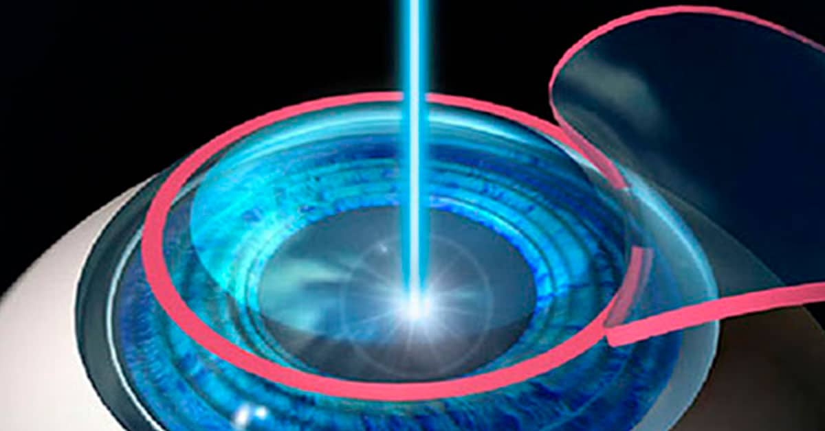 Cirurgia Refrativa a Laser | NeoOftalmo