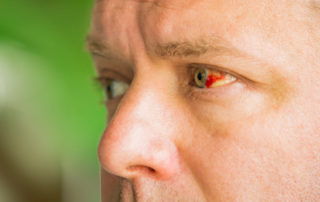 “Sangue nos olhos”: entenda o que é hemorragia subconjuntival