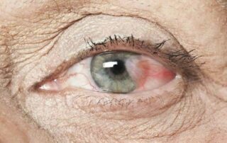 Cirurgia de Pterígio: tire suas dúvidas sobre o procedimento!