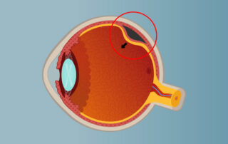 O descolamento de retina é considerado caso de urgência!