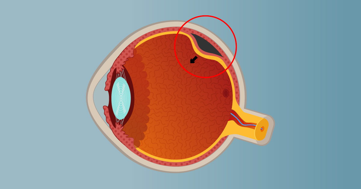 O descolamento de retina é considerado caso de urgência!