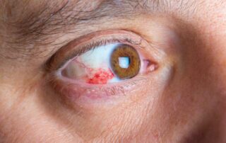 Como a retinopatia diabética afeta a visão?