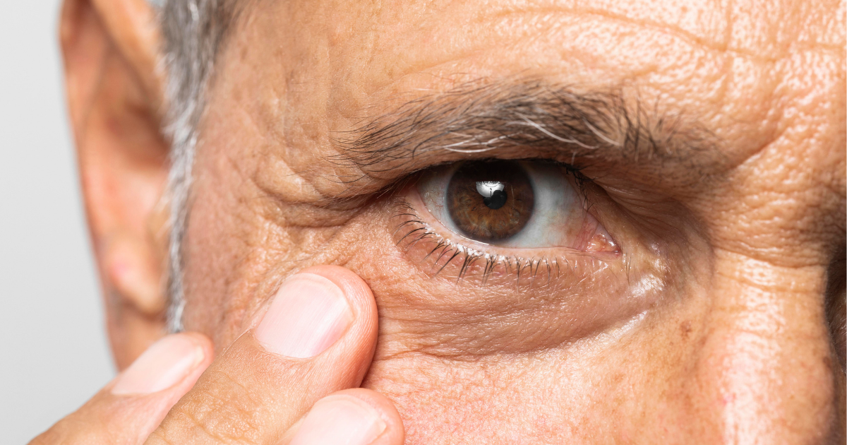 vabysmo para tratamento de DMRI